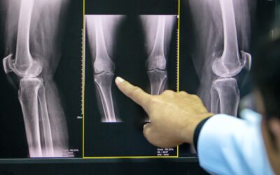 Comprehensive Guide to Non-Surgical Treatment Options for Arthritis: Regain Comfort and Mobility